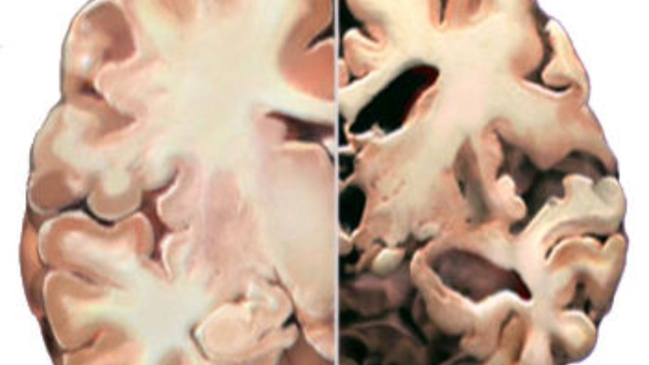Como lidar com quem tem a Doença de Alzheimer?