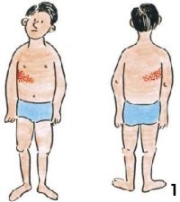 Herpes Zóster